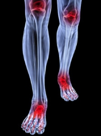 Can Arthritis Affect the Feet?