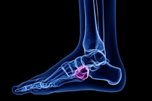Managing Cuboid Bone Injuries